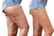 Cellulite loswerden